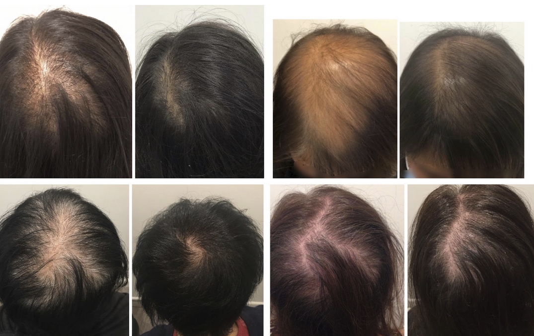 A Guide to Hair Loss Treatment Centres in Sydney and Melbourne